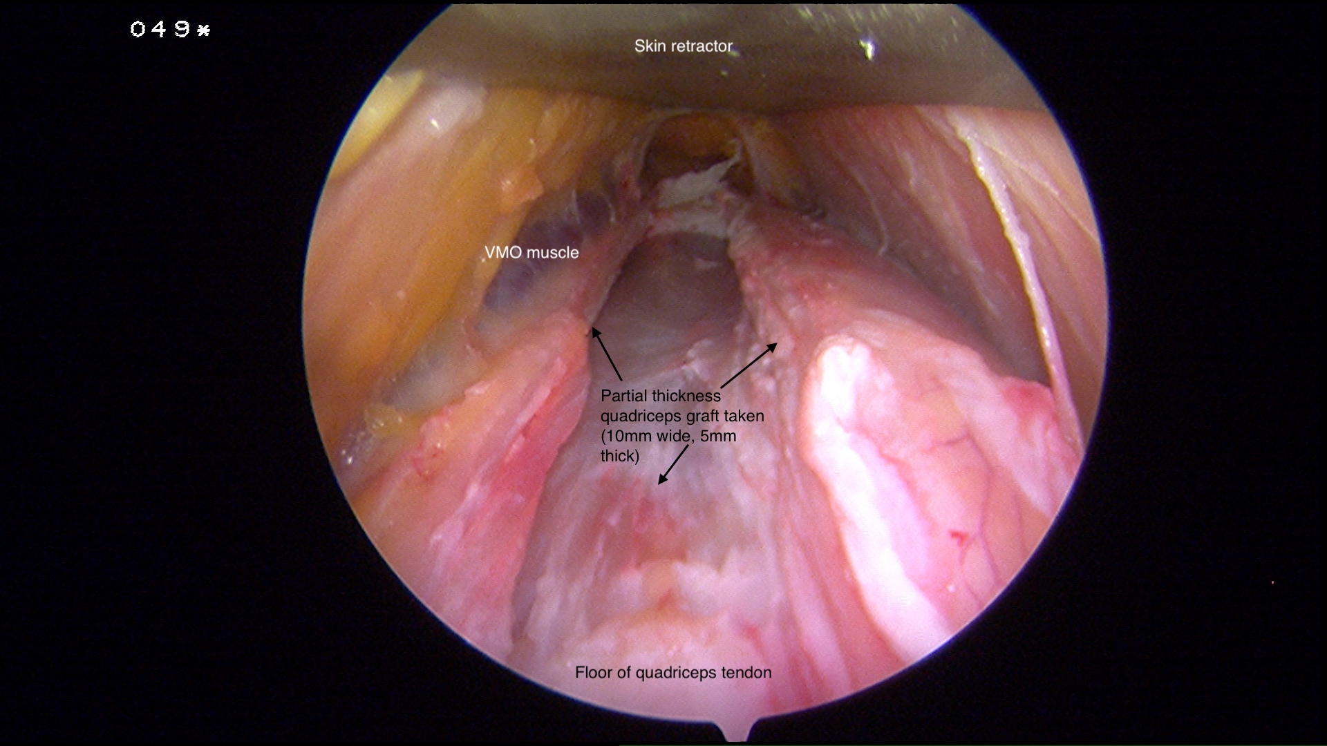 Quadriceps Graft Cork Surgery Orthopaedic Sports Medicine Surgery